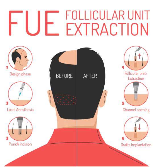 FUE Hair Transplant Los Angeles | Cost in Nuance Plastic Surgery